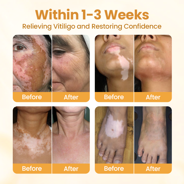 Final 3 Hours: 60% OFF🔥BBOJI™ VitiClear Pro Bee Toxin Cream
