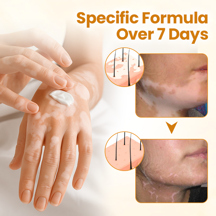 Final 3 Hours: 60% OFF🔥BBOJI™ VitiClear Pro Bee Toxin Cream