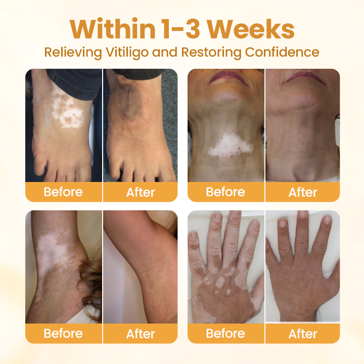 Final 3 Hours: 60% OFF🔥BBOJI™ VitiClear Pro Bee Toxin Cream